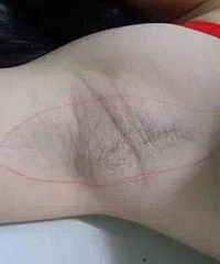 腋下黑色素沉淀好难看,我有几个小秘方分享一下