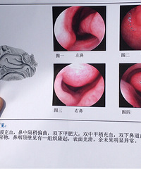 慢性咽炎一直不好,很痛苦,小伙伴们有解决的办法吗?