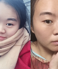 玻尿酸体验归来,一瞬间鼻子就挺了