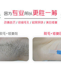 专家解答脱毛的困惑