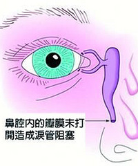 我们幺儿泪道通了!!!!