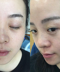 【整容直播室】烦人的雀斑,可以通过这个方式去掉