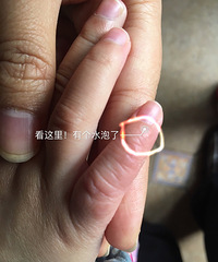 宝宝特性性皮炎