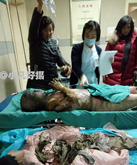 为救残疾父亲 重庆14岁女孩重返火场,全身79%烧伤
