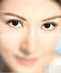 割双眼皮要恢复多久?
