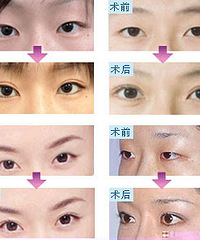 割双眼皮操作详解
