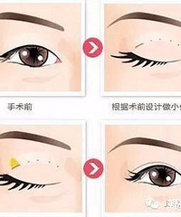 割双眼皮的术后护理