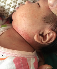 新手妈妈求教,宝宝严重湿疹(有图慎入)