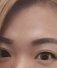 纠结了多年的双眼皮,今天终于做了