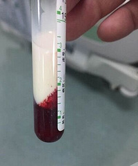 重庆一男子抽血抽出白花花的脂肪,医生都惊呆了...