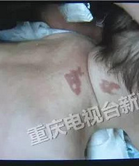 当妈的轻信广告,40天婴儿做推拿被烫伤