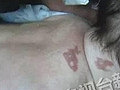 40天婴儿做推拿被烫伤