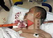 男子被3公分钢钎刺穿颈部,好吓人!所幸已脱离生命危险