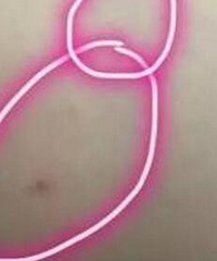 妈妈用录音笔调查真相:2岁半男童浑身是针眼,全是老师杰作