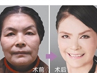 62岁奶奶花200万整成赵雅芝,网友骂她老妖精