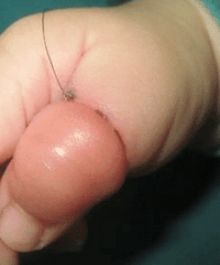揪心!婴儿手被头发缠住险些截肢