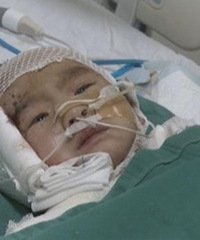 惨不忍睹!3岁男童掉进油盆