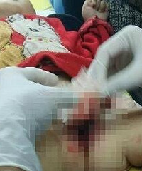 重庆1岁男童被自家狗咬掉生殖器