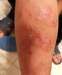 娃儿很严重的湿疹,该怎么办?手跟脚就像是溃烂了一样