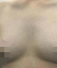 24岁小伙乳房与女子无异