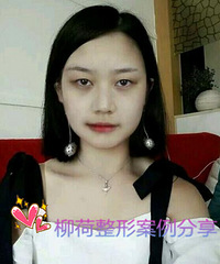 切口双眼皮恢复时间%¥假体隆鼻手术最好的医院