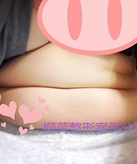 北京做腰腹吸脂手术最好的医生