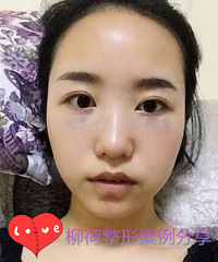 烦人的眼袋终于做掉了,我的迷人大眼呀~