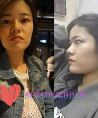 去韩国做了面部改造,朋友都说超级成功呢