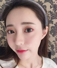 告别塌鼻子的第15天,一天比一天开心