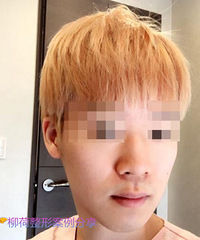 欧巴做的鼻综合看看效果怎么样
