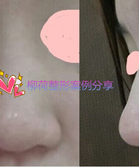 北京做的鼻综合手术大家看看如何呀