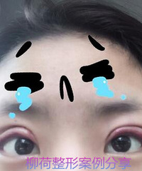 全切双眼皮手术恢复时间¥@全切双眼皮手术最好的医院