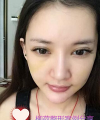 人参娃娃提升恢复时间%¥R人参娃娃手术最好的医院