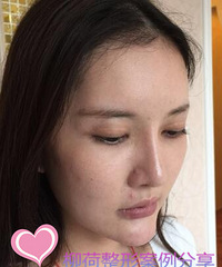 人参娃娃提升恢复时间%¥R人参娃娃手术最好的医院