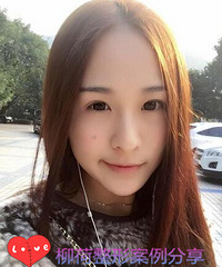 切开双眼皮手术价格%¥内眼角手术对比照片