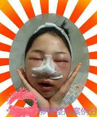 做了颧骨内推和硅胶假体隆鼻手术,很成功哦