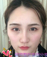 人参娃娃提升手术在柳荷姐姐那里做效果真好呢