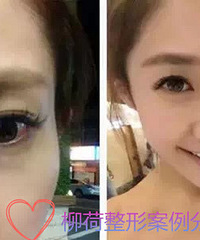 玻尿酸填充太阳穴疼吗 可以维持多久吖