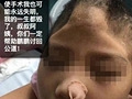男童被虐待致颅骨缺损