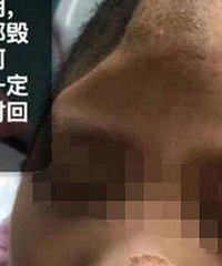 怒!男童遭虐待颅骨缺损