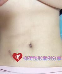 腰腹吸脂手术最好的医院%¥腰腹吸脂价格