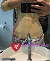 腰腹吸脂手术最好的医院%¥腰腹吸脂价格
