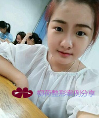 最好的的医院做的双眼皮手术超级自然啊
