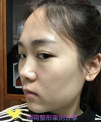 做了硅胶耳软骨隆鼻,满意到飞起啦