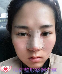 做了硅胶耳软骨隆鼻,满意到飞起啦
