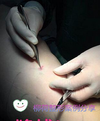 大腿吸脂手术恢复时间%¥吸脂手术最好的医院
