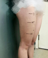 大腿吸脂手术恢复时间%¥吸脂手术最好的医院