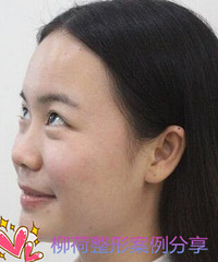 硅胶隆鼻多久能恢复