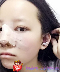 假体隆鼻手术恢复时间%#假体隆鼻手术最好的医院