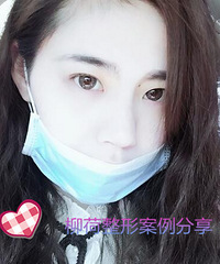 切开双眼皮手术恢复世家%¥开眼角手术会不会留疤啊